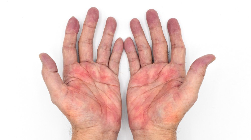 What Causes Palmar Erythema And What Does It Mean For Your Health ...